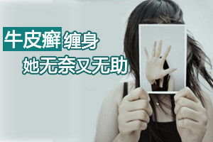 烦人牛皮癣 毁掉了年轻貌美的她