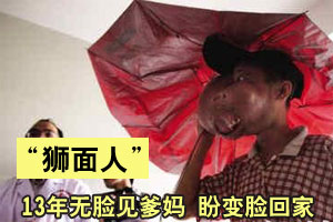 “狮面人”十三年无颜见爹妈 盼变脸回家