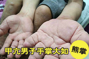 男子手脚肿胀如“熊掌” 比常人大三倍