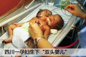 四川一孕妇生下“双头婴儿”（图）