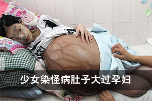 惊！少女染怪病肚子大过孕妇