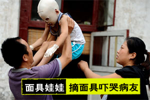 “面具娃娃”进京治疗 摘下头套吓哭病友
