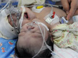 四川“双头女婴”挺过两月 终于迎来手术希望