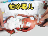 湖南“第一袖珍婴儿”诞生 捧起来像豆腐块