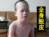 12岁男孩全身无完整皮 走哪脱哪