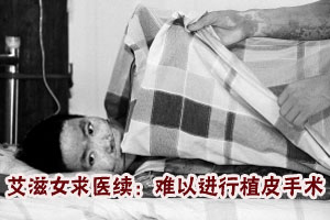 艾滋病毒携带者烧伤求医续 难以进行植皮手术