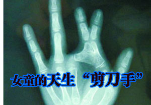 女童天生是“剪刀手” 食指中指下端并连(图)