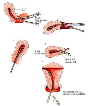 女性上环全过程