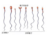 男性精子畸形会导致胎儿畸形吗？