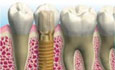 通过种植牙来修复牙齿有无风险