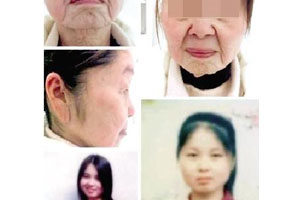 85后女子分娩后形如老太 已接受整容手术