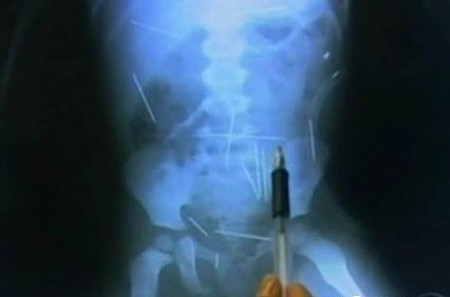 匪夷所思X光片:遗落身体里的自慰品 匪夷所思X光片:遗落身体里的自慰品