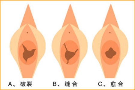 图解处女膜破裂的全过程! 图解处女膜破裂的全过程!
