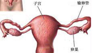 卵巢癌的早期症状有哪些表现?