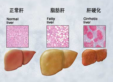 专家：肝硬化绝不是生命的终点站