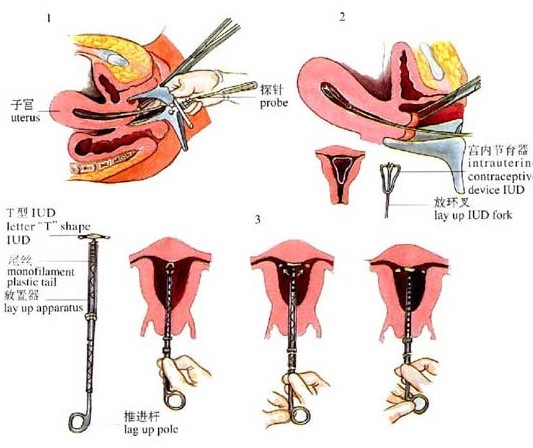 爆！女性上环全过程(多图）