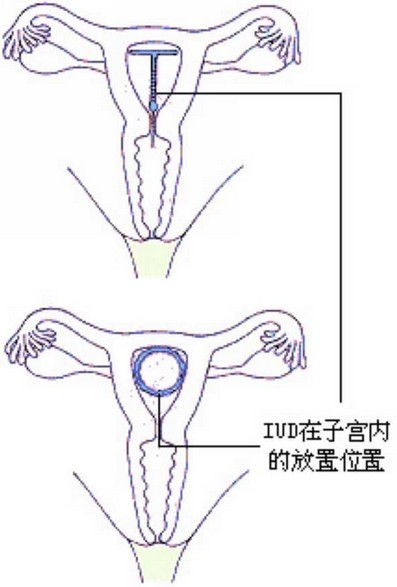 爆!女性上环全过程(多图) 爆!女性上环全过程(多图)