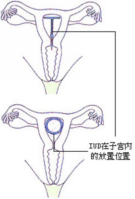 放置宫内节育器后要注意