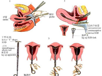 节育器是怎么放进和取出