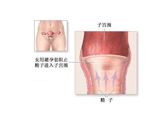 女人怎样避孕