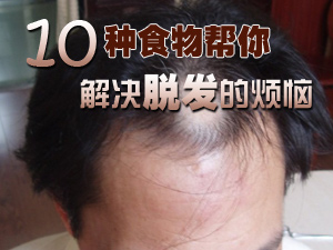防治脱发的食物
