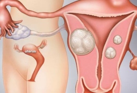 哪些女性易患子宫肌瘤？