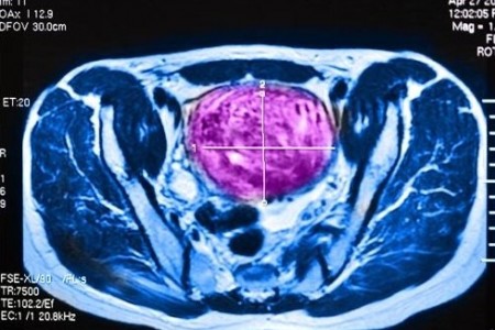 哪些女性易患子宫肌瘤？