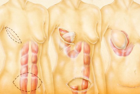 预防乳腺癌:要美丽养生须拒绝要命的癌 预防乳腺癌:要美丽养生须拒绝要命的癌