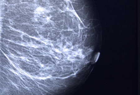预防乳腺癌：要美丽养生须拒绝要命的癌