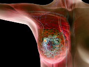 预防乳腺癌：要美丽养生须拒绝要命的癌
