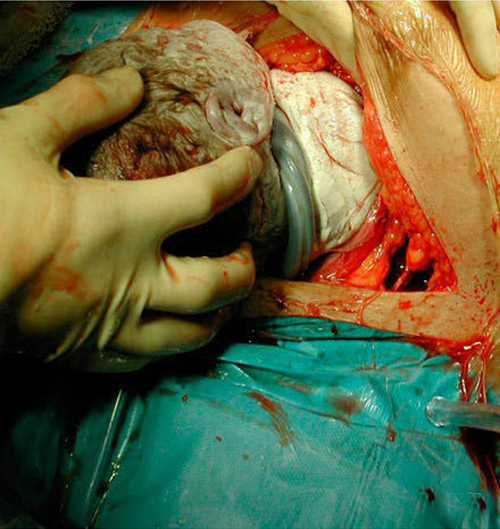 图解剖腹产手术全过程