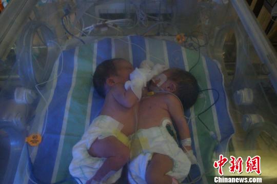 重庆医生跋涉300公里救助初生连体婴 重庆医生跋涉300公里救助初生连体婴重庆医生跋涉300公里救助初生连体婴