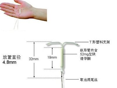 高清图解上环的全过程高清图解上环的全过程