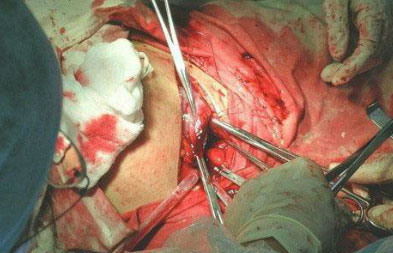 真人版现场剖腹产手术全过程真人版现场剖腹产手术全过程