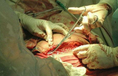 真人版现场剖腹产手术全过程真人版现场剖腹产手术全过程