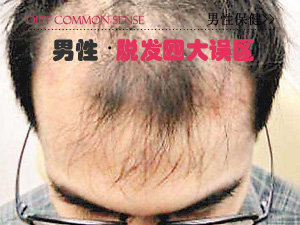 男人脱发四误区