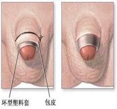 小包皮,大问题,正视男人下半身幸福