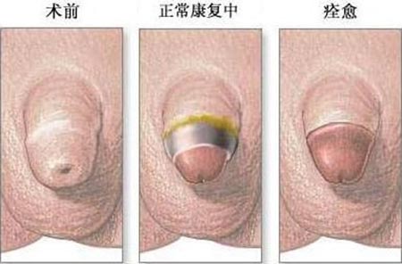 小包皮，大问题，正视男人下半身幸福