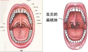 扁桃体炎的症状