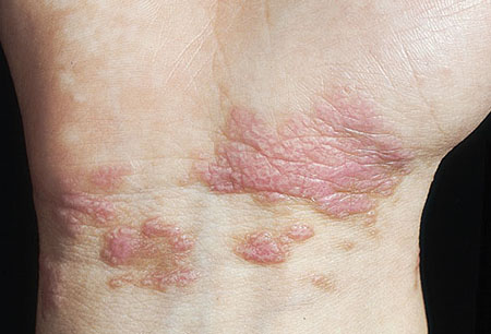 解析皮肤上的疾病信号 可预示严重疾病或癌症