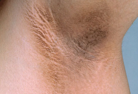 解析皮肤上的疾病信号 可预示严重疾病或癌症