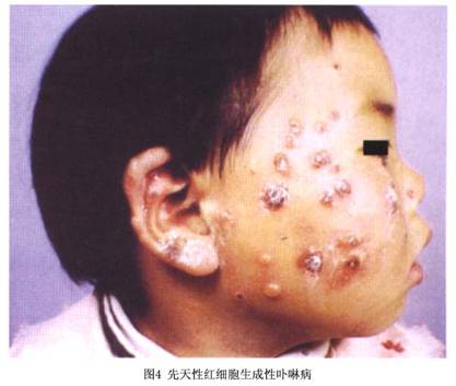 皮肤卟啉病症状_皮肤卟啉病有什么症状_查疾