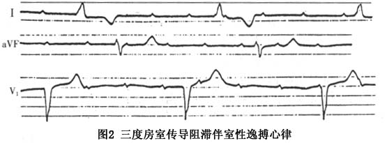 室性逸搏心律的心电图特点   (1)室性逸搏心律的典型心电图特点:   ①