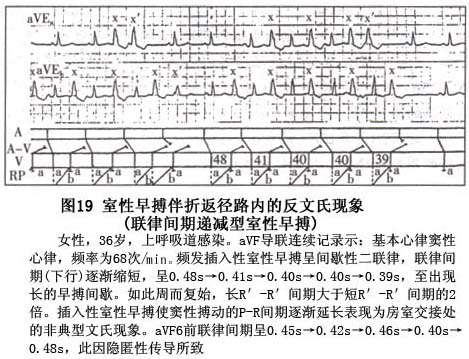 室性期前收缩