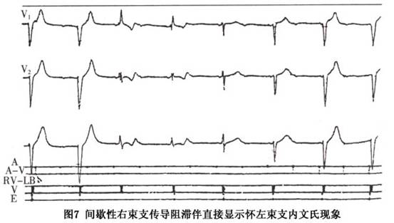 其他所有心搏均显示完全性束支阻滞图形,推测系一不完全性隐匿性束支