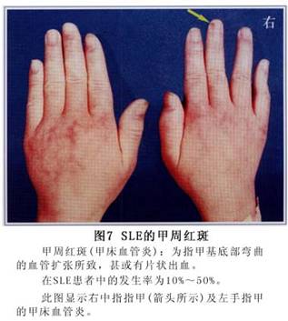 系统性红斑狼疮症状_系统性红斑狼疮有什么症状_查疾病_疾病大全_医网