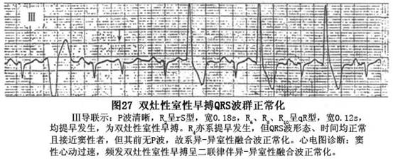 室性期前收缩