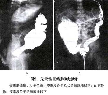 先天性巨结肠