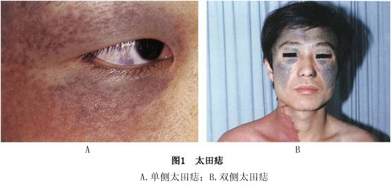 眼颧部褐蓝痣症状_眼颧部褐蓝痣有什么症状_查疾病_疾病大全_医网