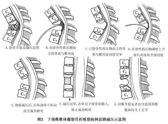 椎体爆裂骨折健康百科